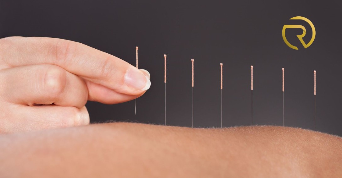 Dry needling